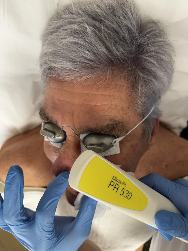 LASER IPL Nordlys PR530 – Traitement Lesions Vasculaires (Visage)