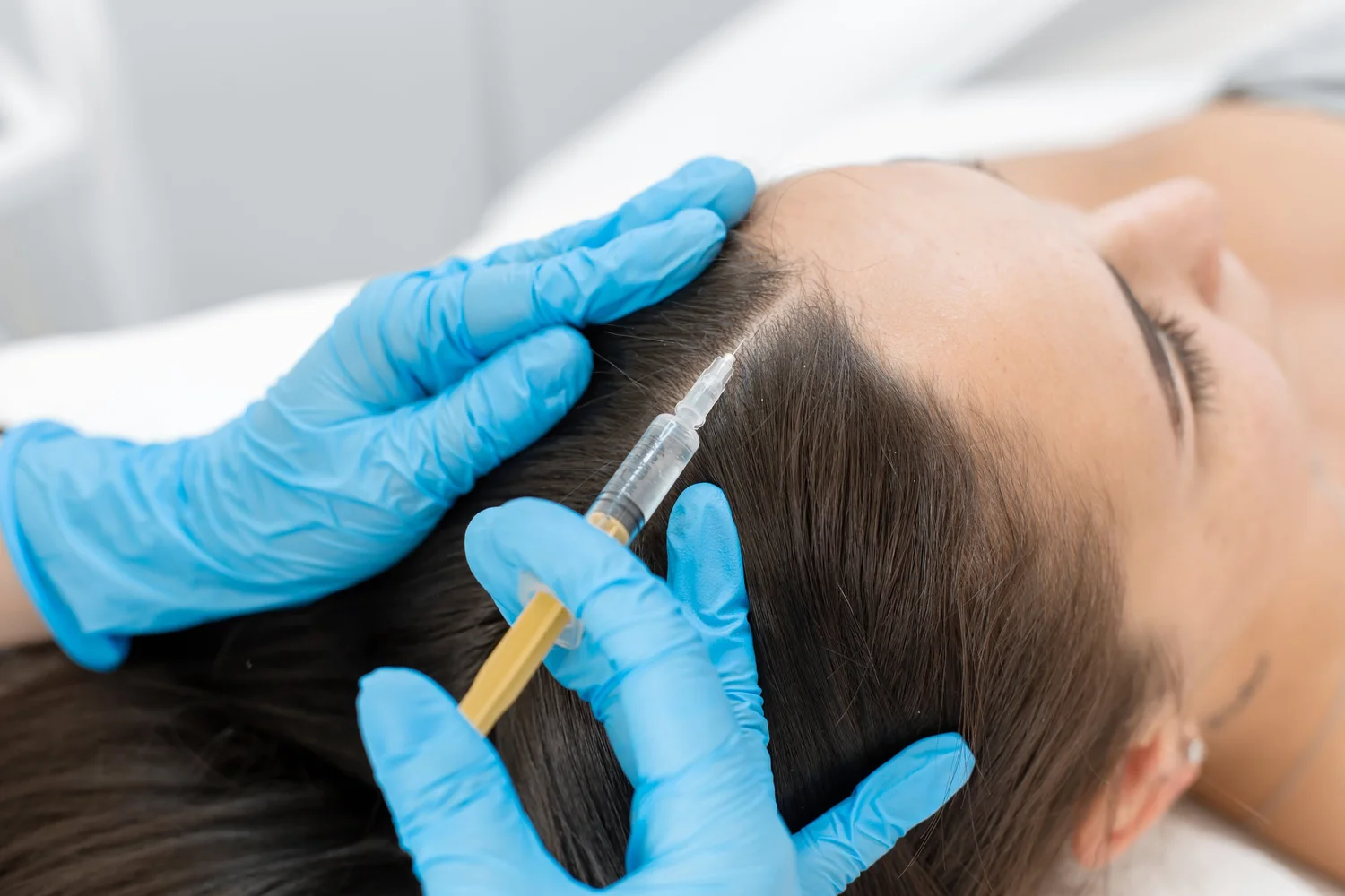 PRP Cheveux – Plasma Riche en Plaquette