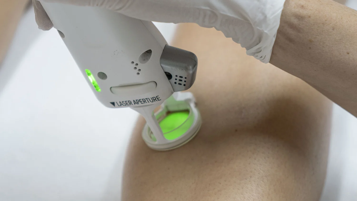 LASER CLARITY III Lutronic – Epilation Laser Visage